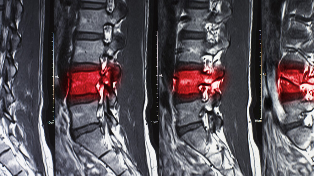 Abogados de lesiones de la médula espinal en Nueva York